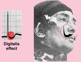Dépression du segment ST en moustache de Salvador Dalí